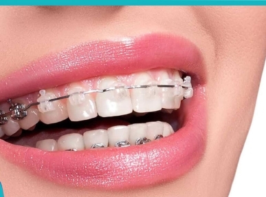 Niềng răng kết hợp nhổ răng khôn tại Nha Khoa Hoa Lê – Giải pháp an toàn và hiệu quả